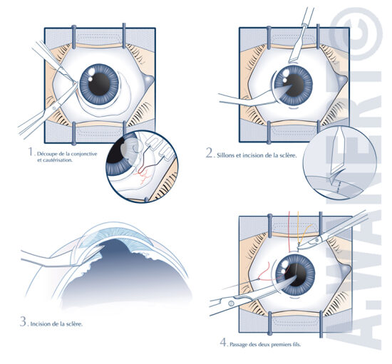 Ophtalmologie