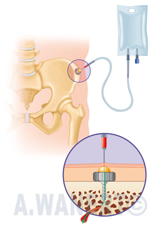 Méthode de perfusion