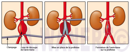 Chirurgie vasculaire